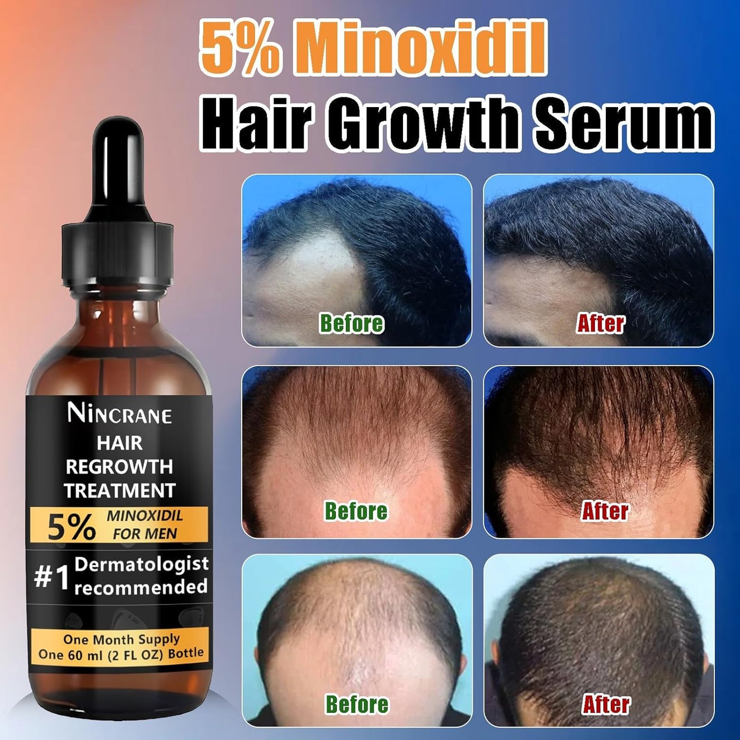 5% Minoxidil Hair Regrowth and Beard Growth Kit